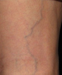 c1 spider veins 2