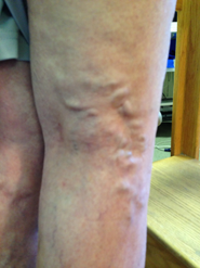 c2-varicose-veins-2
