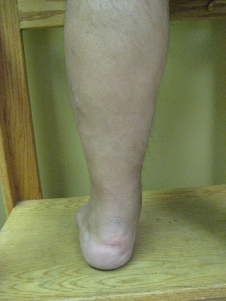 c3 edema